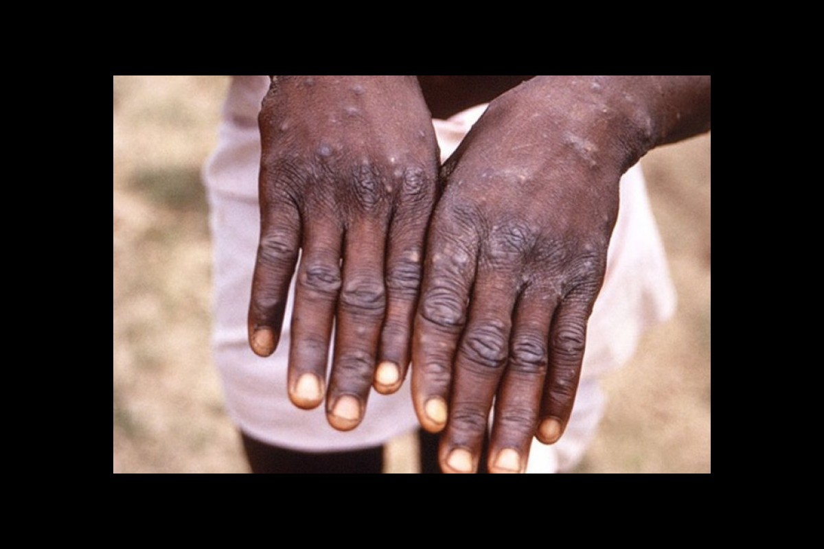 Congo announces outbreak of MPOX