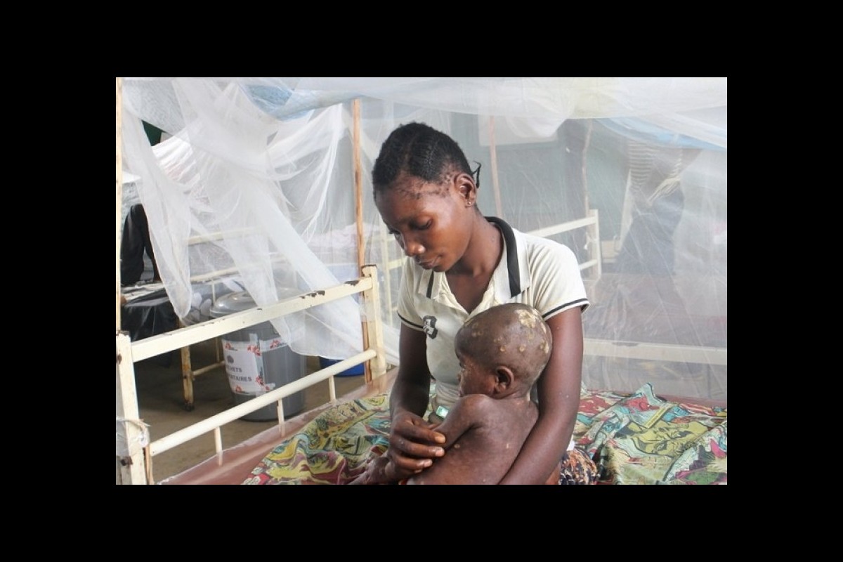 The Democratic Republic of Congo will warn about the increase in MPOX