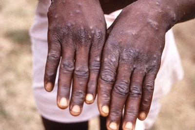 Congo announces outbreak of MPOX
