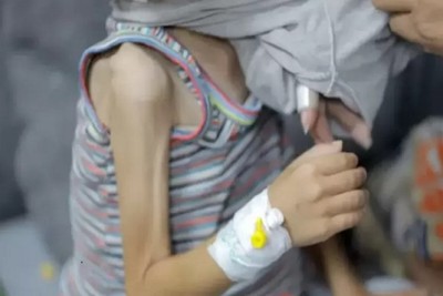 يونيسيف: 30% من الأطفال في قطاع غزة يعانون سوء التَّغذية الحاد