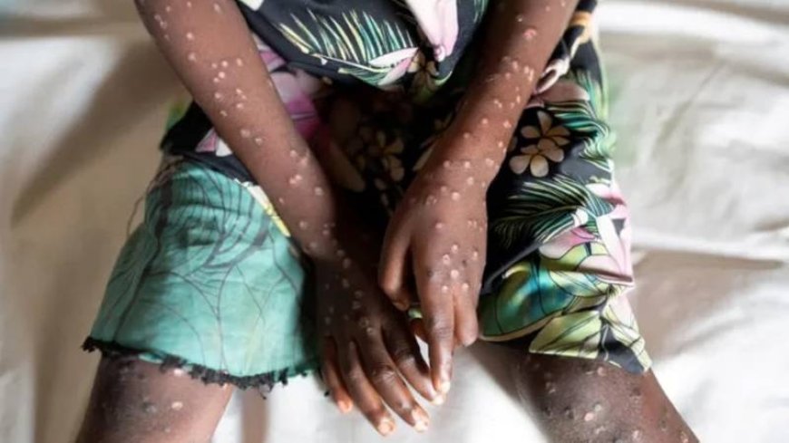 UNICEF wants 58.8 million dollars to stop the mpox outbreak in Africa